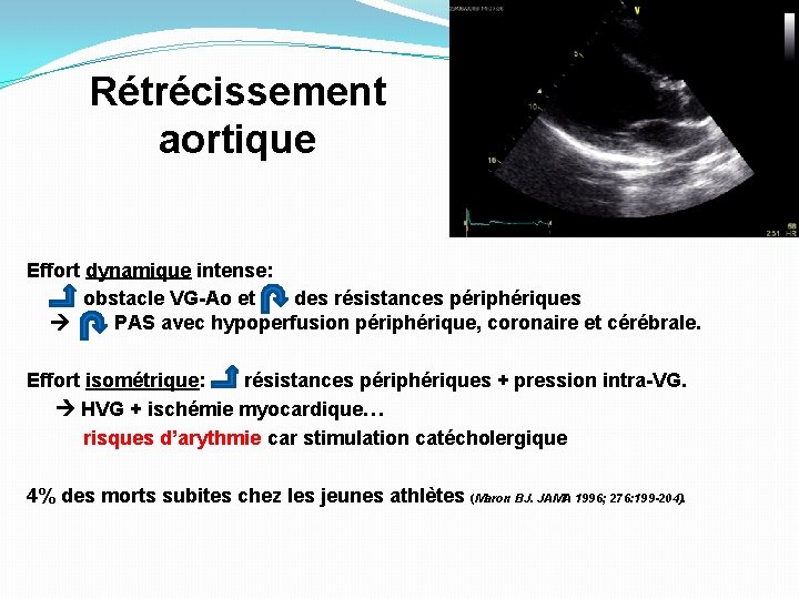 Rétrécissement aortique Effort dynamique intense: obstacle VG-Ao et des résistances périphériques PAS avec hypoperfusion