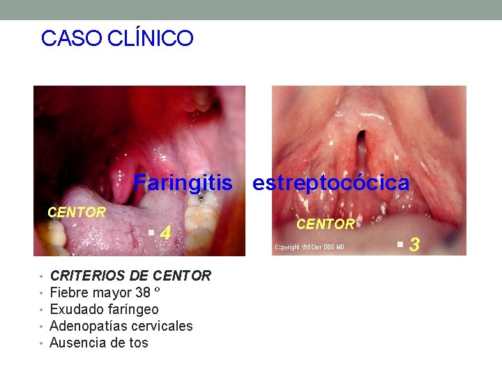 CASO CLÍNICO Faringitis estreptocócica CENTOR § 4 • • • CRITERIOS DE CENTOR Fiebre