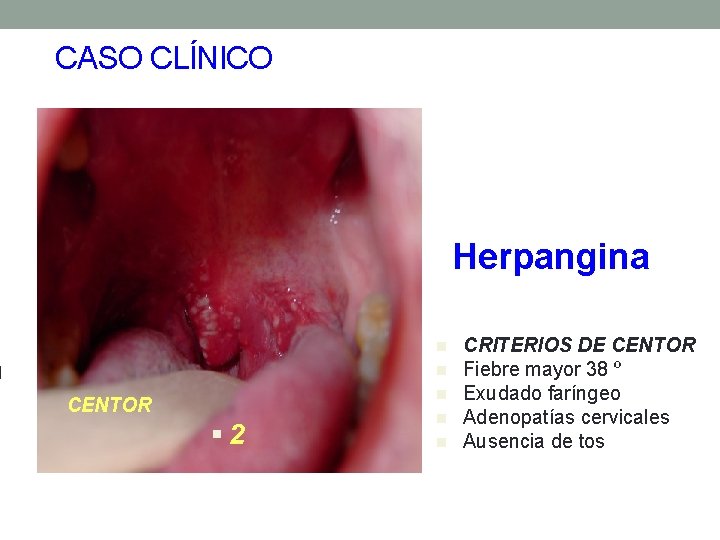 CASO CLÍNICO Herpangina n n n CENTOR § 2 n n CRITERIOS DE CENTOR