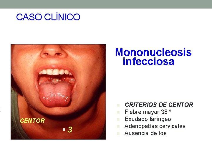 CASO CLÍNICO Mononucleosis infecciosa n n n CENTOR § 3 n n CRITERIOS DE