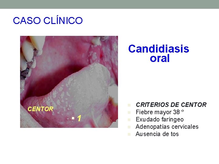 CASO CLÍNICO Candidiasis oral n CENTOR § 1 n n CRITERIOS DE CENTOR Fiebre