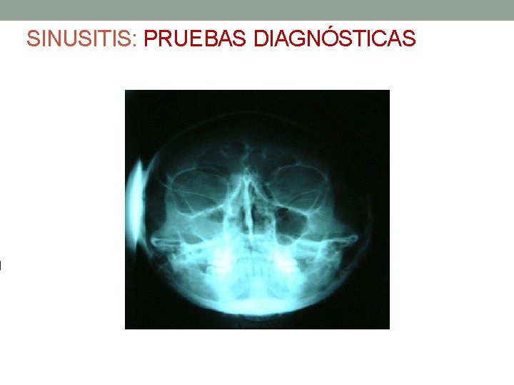 SINUSITIS: PRUEBAS DIAGNÓSTICAS 