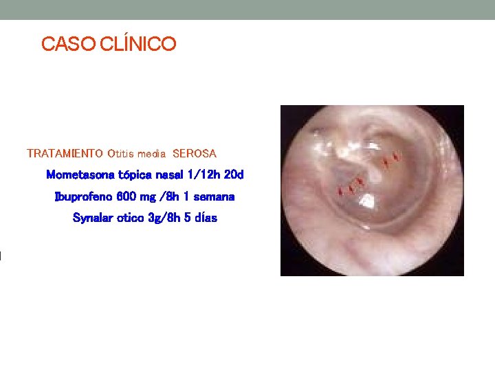 CASO CLÍNICO TRATAMIENTO Otitis media SEROSA Mometasona tópica nasal 1/12 h 20 d Ibuprofeno