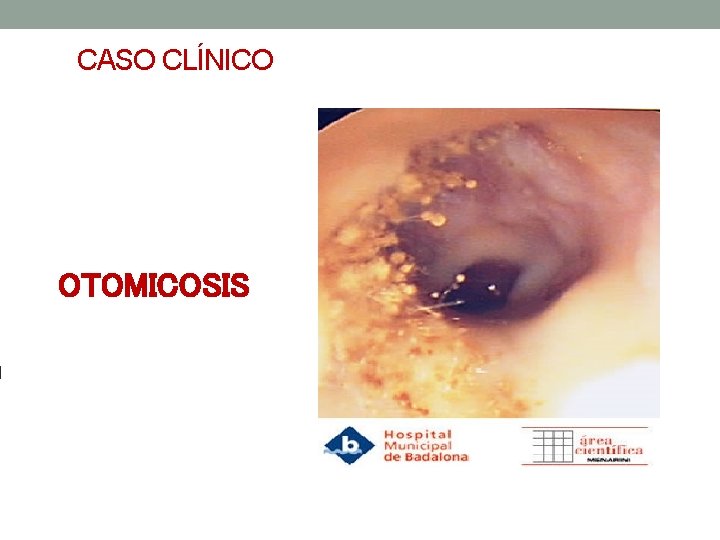 CASO CLÍNICO OTOMICOSIS 