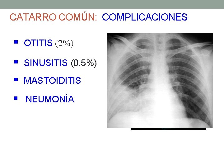 CATARRO COMÚN: COMPLICACIONES § OTITIS (2%) § SINUSITIS (0, 5%) § MASTOIDITIS § NEUMONÍA