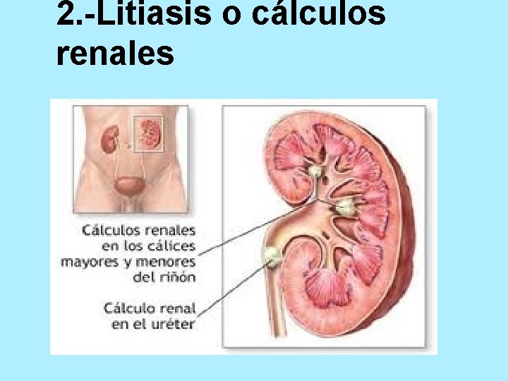 2. -Litiasis o cálculos renales 