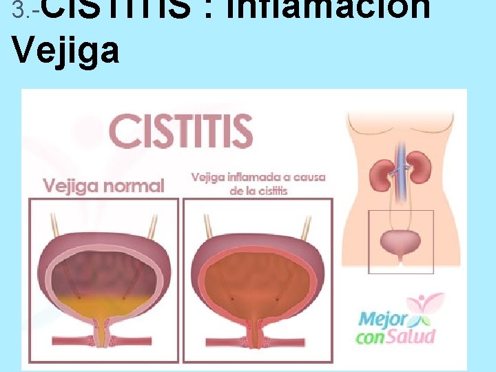 3. -CISTITIS Vejiga : Inflamación 