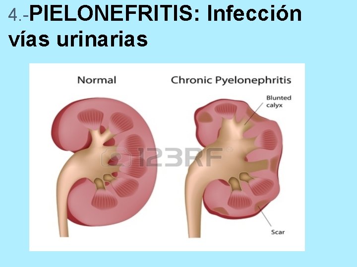 4. -PIELONEFRITIS: vías urinarias Infección 