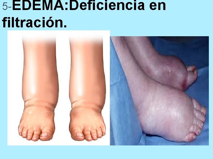 5 -EDEMA: Deficiencia filtración. en 