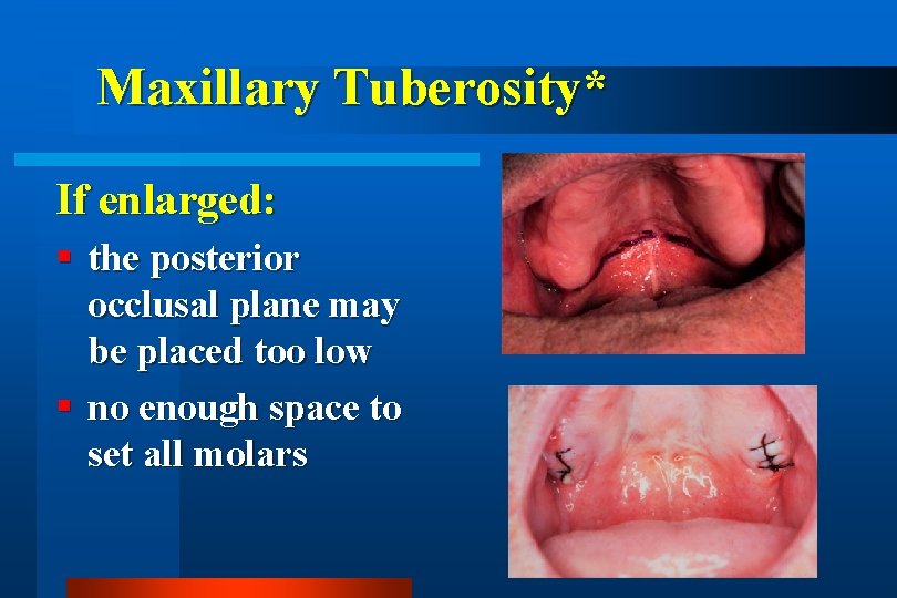 Maxillary Tuberosity* If enlarged: the posterior occlusal plane may be placed too low no