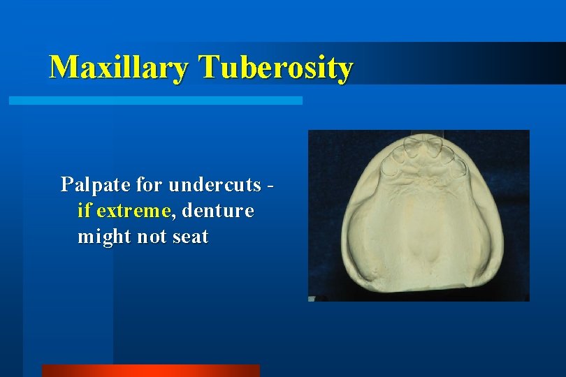 Maxillary Tuberosity Palpate for undercuts if extreme, denture might not seat 