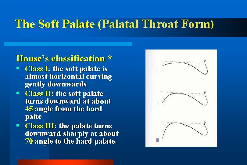 The Soft Palate (Palatal Throat Form) House’s classification * Class I: the soft palate