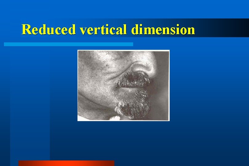 Reduced vertical dimension 