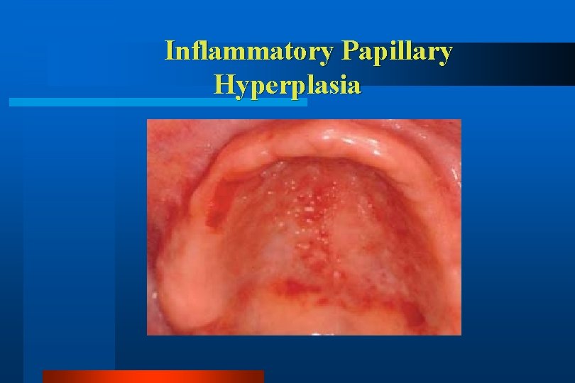 Inflammatory Papillary Hyperplasia 