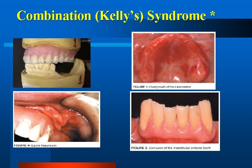 Combination (Kelly’s) Syndrome * 