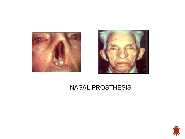 NASAL PROSTHESIS 