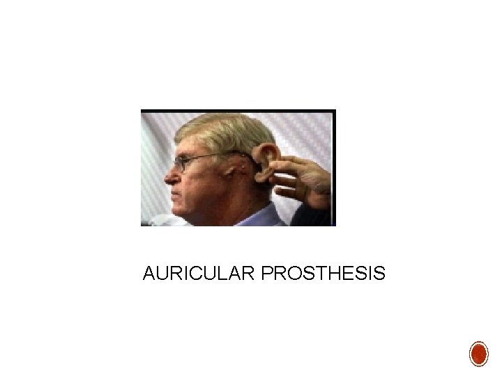 AURICULAR PROSTHESIS 