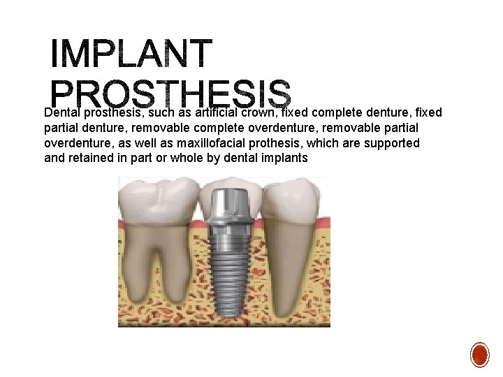 Dental prosthesis, such as artiﬁcial crown, ﬁxed complete denture, ﬁxed partial denture, removable complete