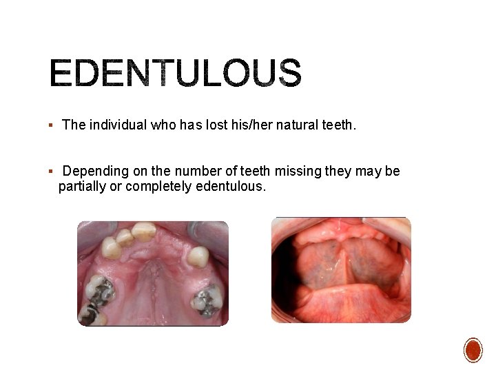 § The individual who has lost his/her natural teeth. § Depending on the number