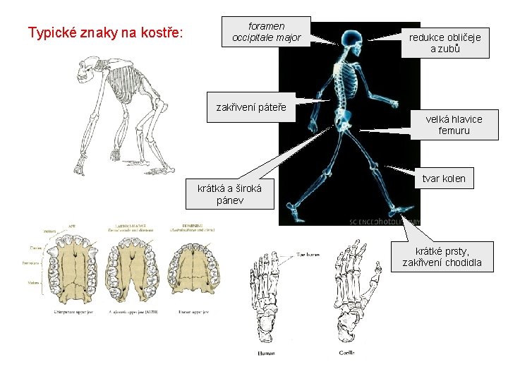 Typické znaky na kostře: foramen occipitale major redukce obličeje a zubů zakřivení páteře velká