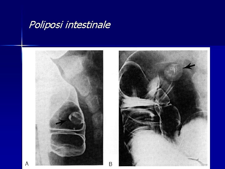 Poliposi intestinale 