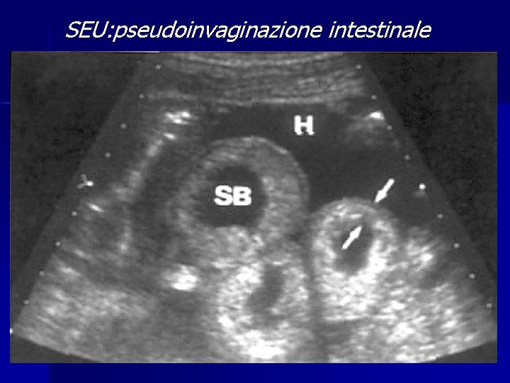 SEU: pseudoinvaginazione intestinale 