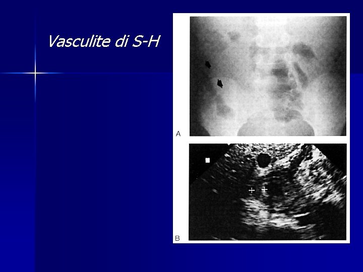 Vasculite di S-H 