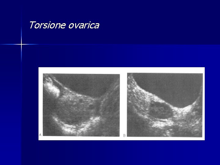 Torsione ovarica 