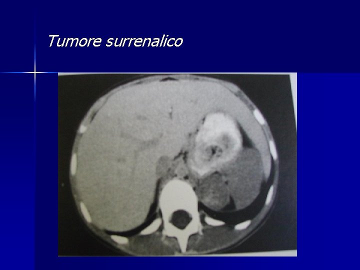 Tumore surrenalico 