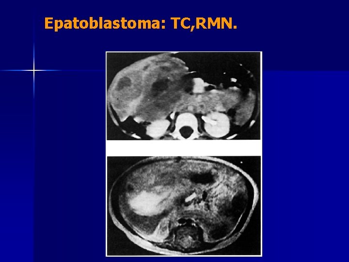 Epatoblastoma: TC, RMN. 