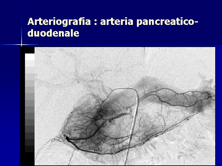 Arteriografia : arteria pancreaticoduodenale 