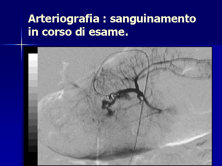 Arteriografia : sanguinamento in corso di esame. 