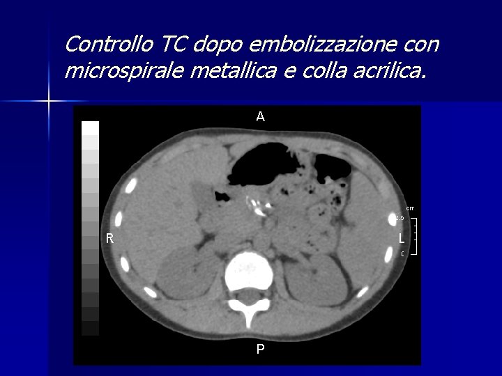 Controllo TC dopo embolizzazione con microspirale metallica e colla acrilica. 