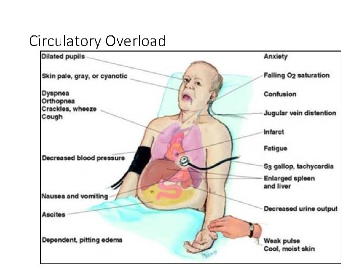 Circulatory Overload 