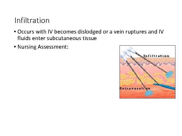 Infiltration • Occurs with IV becomes dislodged or a vein ruptures and IV fluids