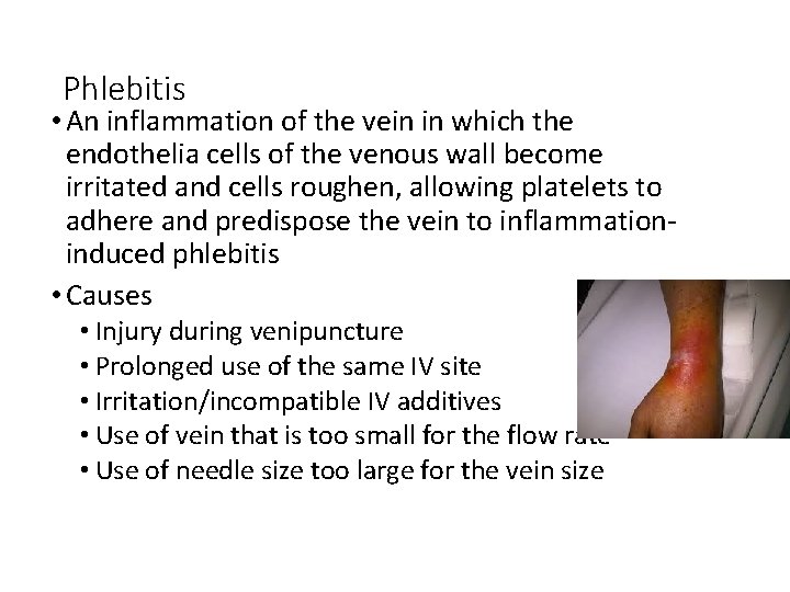Phlebitis • An inflammation of the vein in which the endothelia cells of the