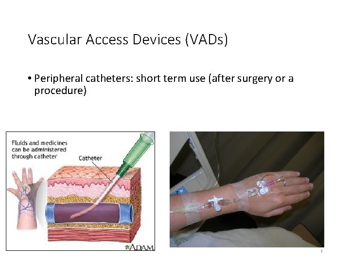 Vascular Access Devices (VADs) • Peripheral catheters: short term use (after surgery or a