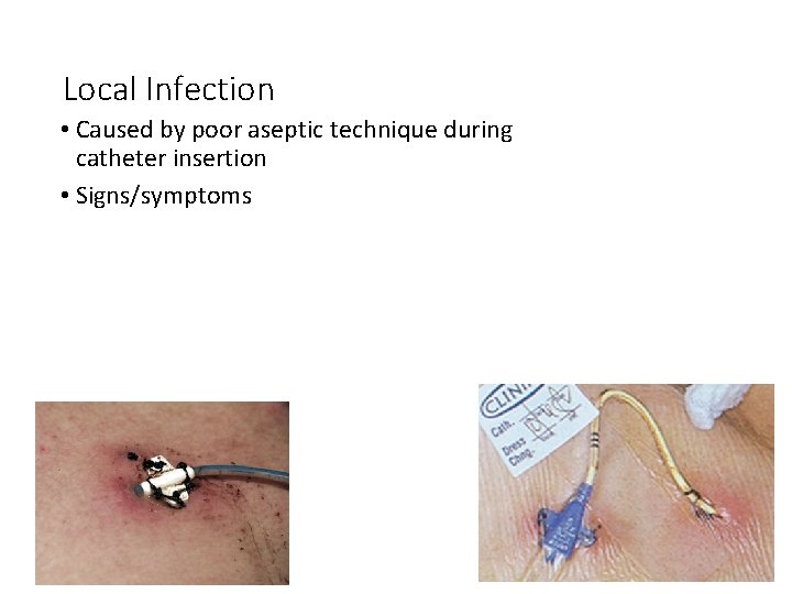 Local Infection • Caused by poor aseptic technique during catheter insertion • Signs/symptoms 
