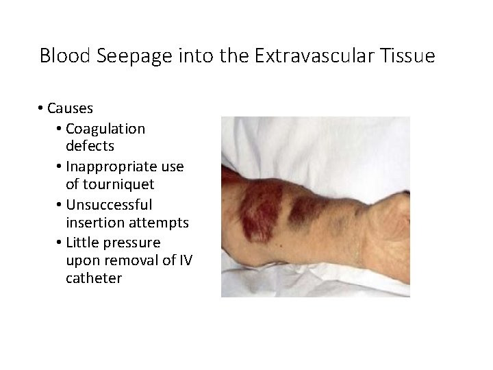 Blood Seepage into the Extravascular Tissue • Causes • Coagulation defects • Inappropriate use