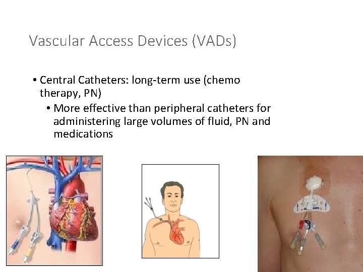 Vascular Access Devices (VADs) • Central Catheters: long-term use (chemo therapy, PN) • More