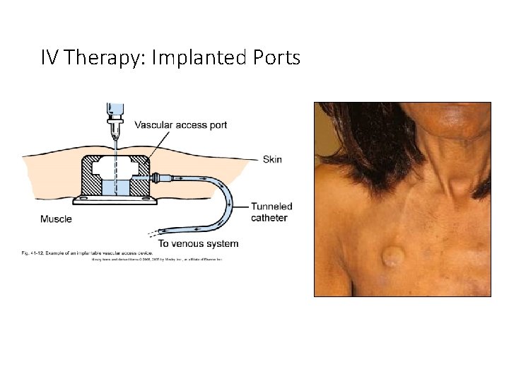 IV Therapy: Implanted Ports 