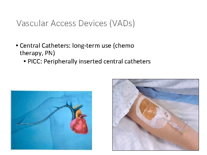 Vascular Access Devices (VADs) • Central Catheters: long-term use (chemo therapy, PN) • PICC: