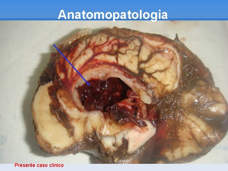 Anatomopatologia Presente caso clínico 