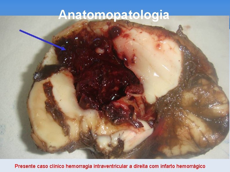 Anatomopatologia Presente caso clínico hemorragia intraventricular a direita com infarto hemorrágico 