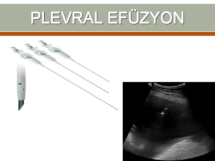 PLEVRAL EFÜZYON PLEVRAL EFÜZYON