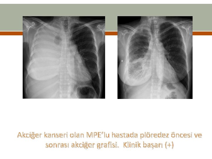 Akciğer kanseri olan MPE’lu hastada plöredez öncesi ve sonrası akciğer grafisi. Klinik başarı (+) Akciğer kanseri olan MPE’lu hastada plöredez öncesi ve sonrası akciğer grafisi. Klinik başarı (+)
