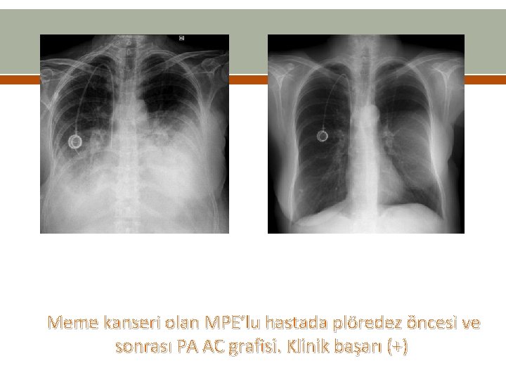 Meme kanseri olan MPE’lu hastada plöredez öncesi ve sonrası PA AC grafisi. Klinik başarı Meme kanseri olan MPE’lu hastada plöredez öncesi ve sonrası PA AC grafisi. Klinik başarı
