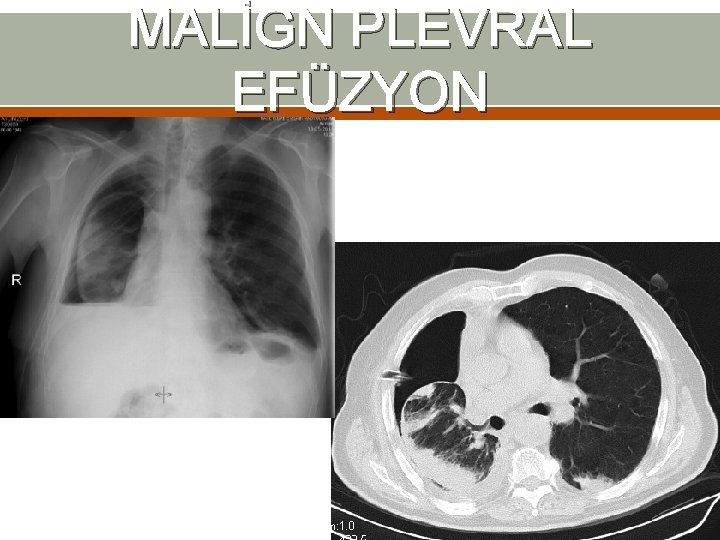 MALİGN PLEVRAL EFÜZYON MALİGN PLEVRAL EFÜZYON