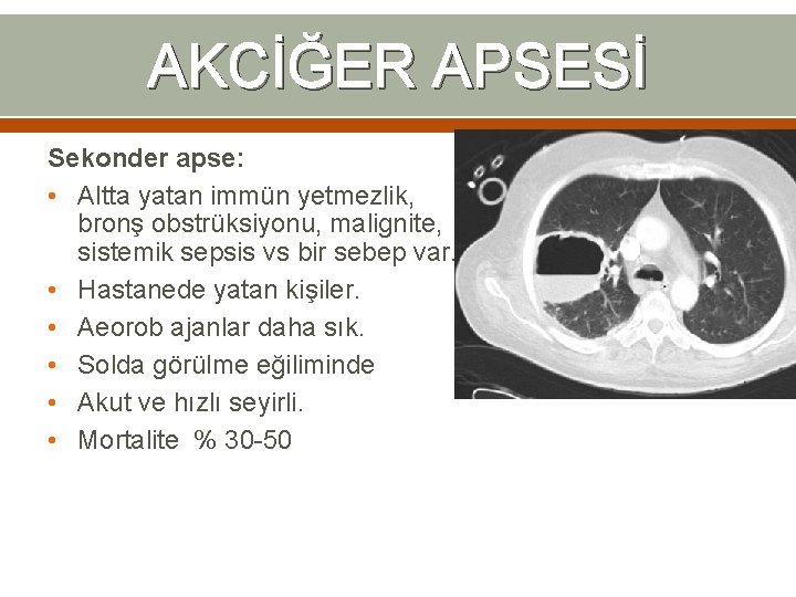 AKCİĞER APSESİ Sekonder apse: • Altta yatan immün yetmezlik, bronş obstrüksiyonu, malignite, sistemik sepsis AKCİĞER APSESİ Sekonder apse: • Altta yatan immün yetmezlik, bronş obstrüksiyonu, malignite, sistemik sepsis