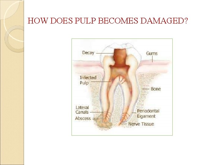 HOW DOES PULP BECOMES DAMAGED? 